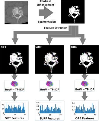 Computer-Aided Diagnosis of Spinal Tuberculosis From CT Images Based on Deep Learning With Multimodal Feature Fusion